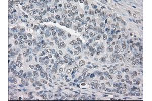 Immunohistochemical staining of paraffin-embedded Adenocarcinoma of breast tissue using anti-PPP5C mouse monoclonal antibody.
