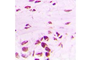 Immunohistochemical analysis of PLK1 (pT210) staining in human lung cancer formalin fixed paraffin embedded tissue section. (PLK1 antibody  (pSer210))