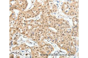 Immunohistochemistry of Human lung cancer using PAX7 Polyclonal Antibody at dilution of 1:35 (PAX7 antibody)