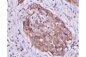 Formalin-fixed and paraffin embedded human cervical tissue labeled with Anti-STAT3 Polyclonal Antibody , Unconjugated at 1:200 followed by conjugation to the secondary antibody, (SP-0023), and DAB staining