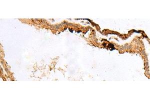 Immunohistochemistry of paraffin-embedded Human thyroid cancer tissue using RABGGTA Polyclonal Antibody at dilution of 1:50(x200) (RABGGTA antibody)