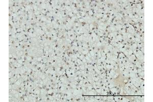 Immunoperoxidase of monoclonal antibody to AR on formalin-fixed paraffin-embedded human renal cell carcinoma tissue. (Androgen Receptor antibody  (AA 221-320))