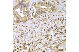 Immunohistochemistry of paraffin-embedded human liver cancer using FSCN1 antibody. (Fascin antibody)