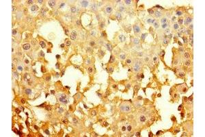 Immunohistochemistry of paraffin-embedded human breast cancer using ABIN7153625 at dilution of 1:100 (GJB6 antibody  (AA 216-261))