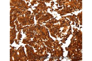 Immunohistochemistry of Human gastic cancer using ALDOA Polyclonal Antibody at dilution of 1:30