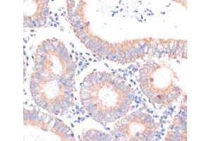 Immunohistochemistry of paraffin-embedded Human colon carcinoma using EIF4EBP1 Polyclonal Antibody at dilution of 1:100 (40x lens). (eIF4EBP1 antibody)