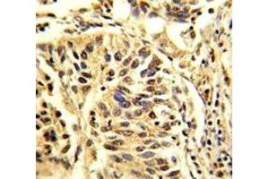 IHC analysis of FFPE human lung carcinoma stained with CEBPB antibody (CEBPB antibody  (AA 271-298))