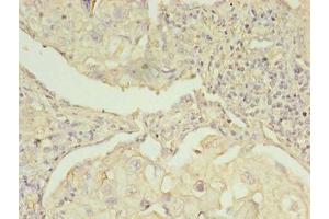 Immunohistochemistry of paraffin-embedded human lung cancer using ABIN7142288 at dilution of 1:100 (EBP antibody  (AA 2-230))