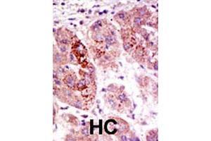 Formalin-fixed and paraffin-embedded human hepatocellular carcinoma tissue reacted with the USP7 polyclonal antibody  , which was peroxidase-conjugated to the secondary antibody, followed by AEC staining . (USP7 antibody  (C-Term))