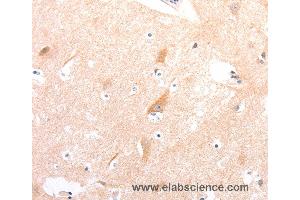 Immunohistochemistry of Human colon cancer using CELSR2 Polyclonal Antibody at dilution of 1:50 (CELSR2 antibody)