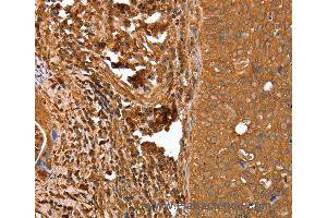 Immunohistochemistry of Human cervical cancer using CNN3 Polyclonal Antibody at dilution of 1:25
