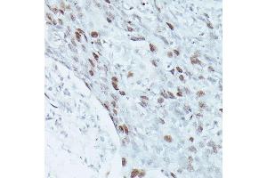 Immunohistochemistry of paraffin-embedded human breast cancer using MEF2C antibody (ABIN3023393, ABIN3023394, ABIN3023395 and ABIN6219695) at dilution of 1:100 (40x lens).