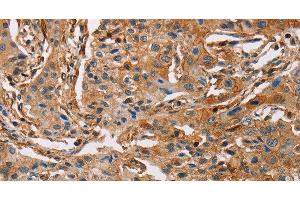Immunohistochemistry of paraffin-embedded Human lung cancer using ACTA1 Polyclonal Antibody at dilution of 1:65 (Actin antibody)