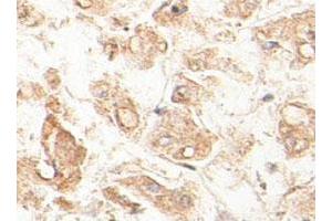 Immunohistochemical staining of formalin-fixed paraffin-embedded human fetal liver tissue showing cytoplasmic staining with ACAA1 polyclonal antibody  at 1 : 100 dilution. (ACAA1 antibody  (AA 210-424))