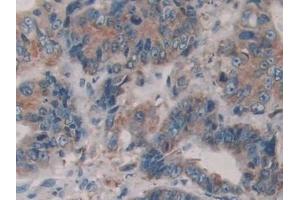 Detection of PDIA4 in Human Colorectal cancer Tissue using Polyclonal Antibody to Protein Disulfide Isomerase A4 (PDIA4) (PDIA4 antibody  (AA 505-636))