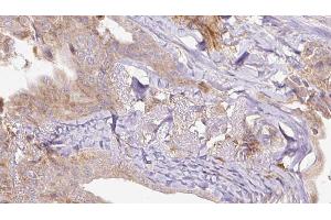 ABIN6273305 at 1/100 staining Human thyroid cancer tissue by IHC-P.