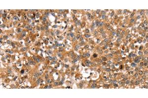 Immunohistochemistry of paraffin-embedded Human lung cancer using STAR Polyclonal Antibody at dilution of 1:35 (STAR antibody)