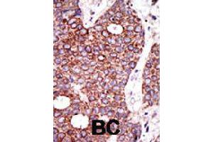 Formalin-fixed and paraffin-embedded human cancer tissue reacted with GCNT1 polyclonal antibody  , which was peroxidase-conjugated to the secondary antibody, followed by DAB staining . (GCNT1 antibody  (C-Term))