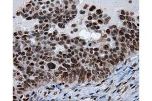 Immunohistochemical staining of paraffin-embedded Adenocarcinoma of breast tissue using anti-SIL1 mouse monoclonal antibody. (SIL1 antibody)