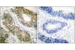 Immunohistochemistry analysis of paraffin-embedded human colon carcinoma tissue, using SEPARASE (Ab-801) Antibody. (Separase antibody  (AA 767-816))