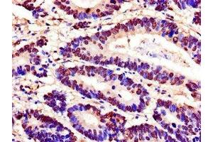 Immunohistochemistry of paraffin-embedded human colon cancer using ABIN7168587 at dilution of 1:100