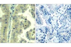Immunohistochemical analysis of paraffin-embedded human lung carcinoma tissue using eIF4G (Ab-1232) Antibody (E021514).