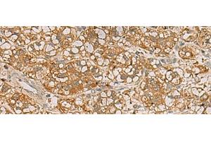 Immunohistochemistry of paraffin-embedded Human liver cancer tissue using QDPR Polyclonal Antibody at dilution of 1:70(x200) (QDPR antibody)