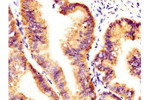 IHC image of ABIN7174056 diluted at 1:400 and staining in paraffin-embedded human endometrial cancer performed on a Leica BondTM system. (AXL antibody  (AA 312-447))