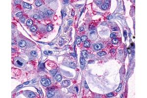 Anti-TAAR9 antibody IHC of human Lung, Adenocarcinoma. (TAAR9 antibody  (Extracellular Domain))