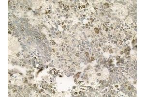 ABIN6256978 and ABIN6273749 at 1/100 staining human melanoma by IHC-P.