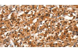 Immunohistochemistry of paraffin-embedded Human thyroid cancer tissue using DDX4 Polyclonal Antibody at dilution 1:40 (DDX4 antibody)