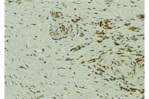 ABIN6273240 at 1/100 staining Human breast cancer tissue by IHC-P. (ETV5 antibody  (Internal Region))