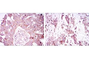 Immunohistochemical analysis of paraffin-embedded ovarian cancer tissues (left) and lung cancer tissues (right) using ATXN1 mouse mAb with DAB staining. (Ataxin 1 antibody)