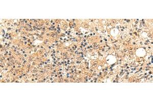 Immunohistochemistry of paraffin-embedded Human esophagus cancer tissue using ZFYVE27 Polyclonal Antibody at dilution of 1:50(x200)
