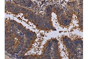 The image on the left is immunohistochemistry of paraffin-embedded Human colon cancer tissue using ABIN7130206(MCTS1 Antibody) at dilution 1/30, on the right is treated with fusion protein. (MCTS1 antibody)
