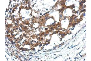IHC-P Image Immunohistochemical analysis of paraffin-embedded human breast cancer, using APAF1, antibody at 1:500 dilution. (APAF1 antibody  (C-Term))