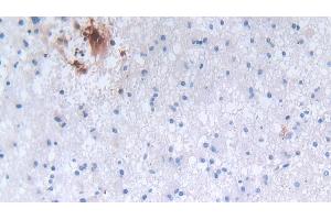 Detection of DEFa3 in Human Glioma Tissue using Polyclonal Antibody to Defensin Alpha 3, Neutrophil Specific (DEFa3) (DEFa3 antibody  (AA 21-94))