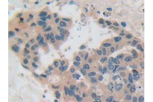 IHC-P analysis of Human Breast cancer Tissue, with DAB staining. (CSN2 antibody  (AA 41-198))