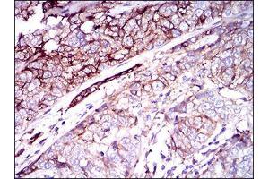 Immunohistochemical analysis of paraffin-embedded bladder cancer tissues using CD59 mouse mAb with DAB staining.