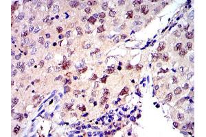 Immunohistochemical analysis of paraffin-embedded lung cancer tissues using MCM2 mouse mAb with DAB staining.
