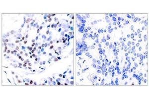 Immunohistochemical analysis of paraffin-embedded human breast carcinoma tissue using c-Jun (Ab-239) antibody (E021024). (C-JUN antibody)