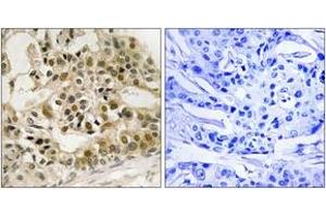 Immunohistochemistry analysis of paraffin-embedded human breast carcinoma, using Myb (Phospho-Ser532) Antibody.