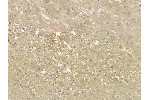 ABIN6264274 and ABIN6276634 at 1/100 staining human glioblastoma by IHC-P.