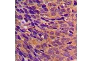 Immunohistochemical analysis of CBR3 staining in human breast cancer formalin fixed paraffin embedded tissue section. (CBR3 antibody)