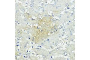 Immunohistochemistry of paraffin-embedded human liver cancer using SOCS5 antibody (ABIN6128734, ABIN6148271, ABIN6148272 and ABIN6223959) at dilution of 1:100 (40x lens). (SOCS5 antibody  (AA 1-140))