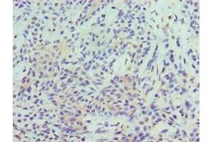 Immunohistochemistry of paraffin-embedded human breast cancer using ABIN7169685 at dilution of 1:100 (STAT5B antibody  (AA 40-280))