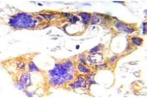 Immunohistochemistry (IHC) analyzes of p-c-RAF antibody in paraffin-embedded human prostate carcinoma tissue.