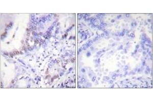 Immunohistochemistry analysis of paraffin-embedded human lung carcinoma, using Abl (Phospho-Tyr412) Antibody.