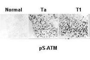 Anti-ATM Monoclonal Antibody - Immunohistochemistry Anti ATM monoclonal Antibody was used to show constitutive activation of the ATM pathway in human urinary bladder cancer. (ATM antibody  (AA 1974-1988))