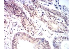 Immunohistochemical analysis of paraffin-embedded colon cancer tissues using KAT7 mouse mAb with DAB staining. (MYST2 antibody  (AA 1-200))